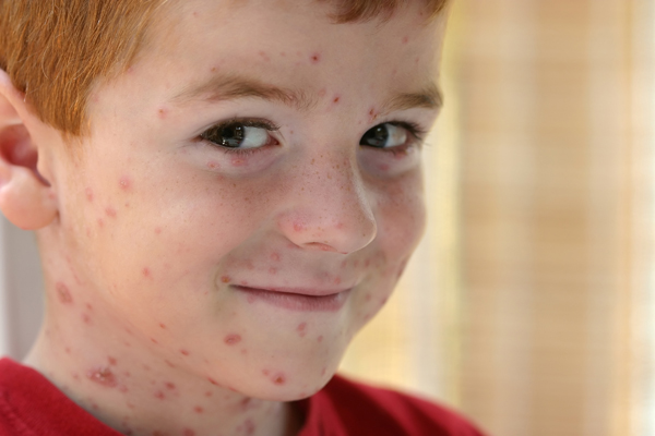 Mon enfant a des boutons et de la fièvre, je crois qu'il a la ...